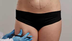 Clinician in blue gloves marks a patients abdomen and hips with a marker for body contouring surgery liposuctionbuttock lift