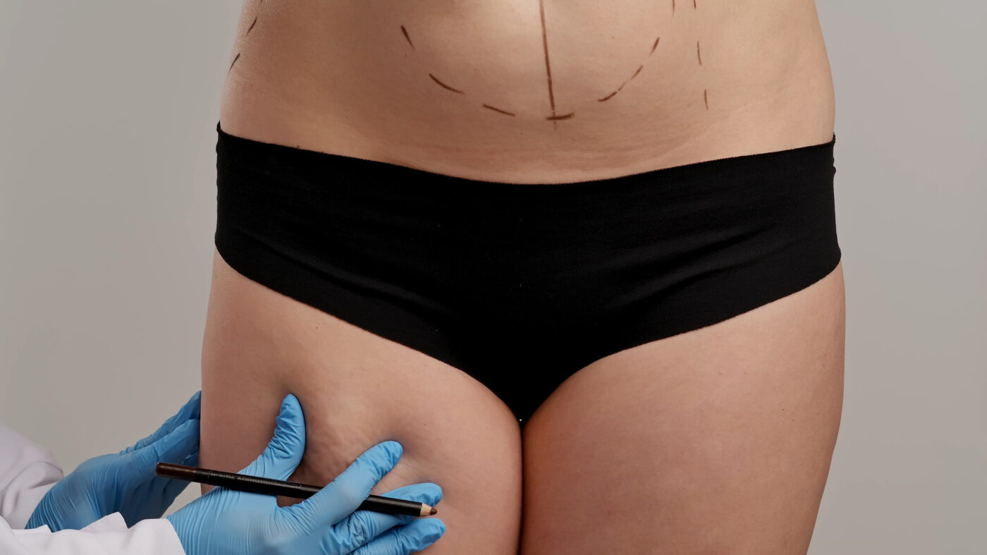 Preparation for Aesthetic Body Contouring Procedure Consultation Andalucía Noticias 24h Clinician in blue gloves marks a patients abdomen and hips with a marker for body contouring surgery liposuctionbuttock lift